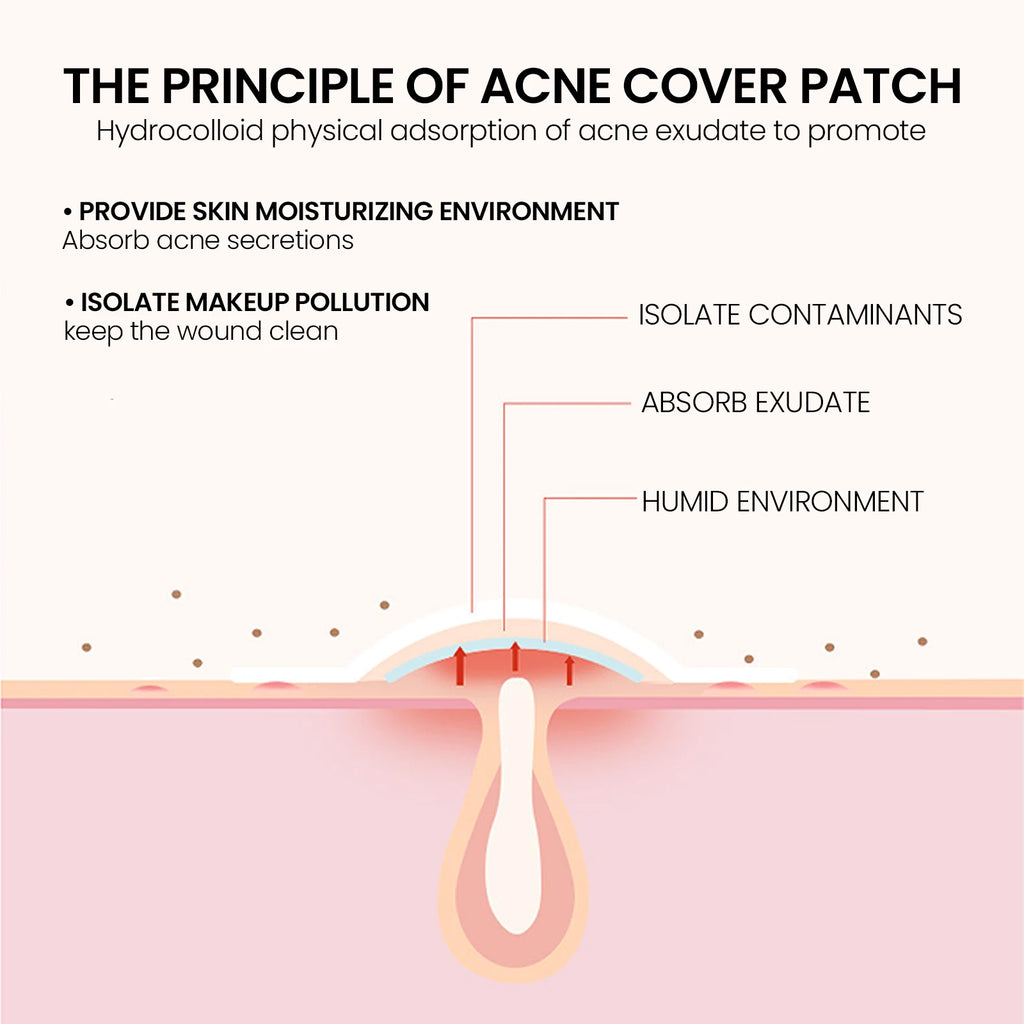 Gentle Waterproof Pimple Patches Deep Clean Acne Eraser - IRON GODDESS